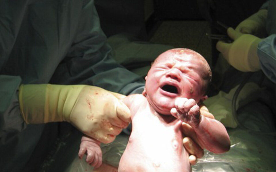 Baby überlebt Fehlgeburt und Abtreibung